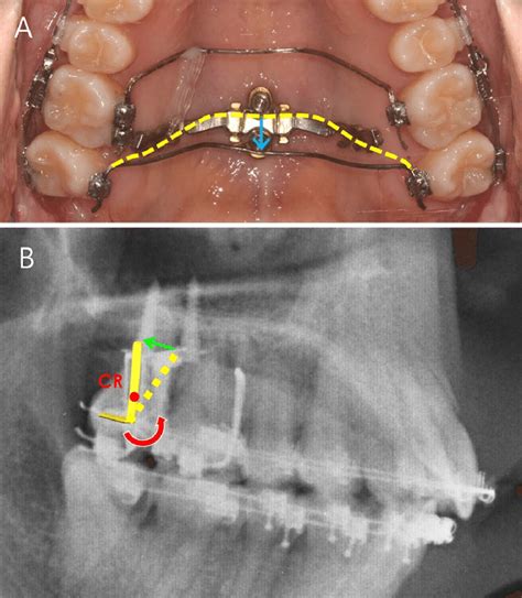 A Transpalatal Arch On Maxillary Second Molars Was Hung On Distal