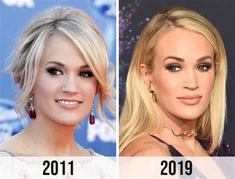 Carrie Underwood and Plastic Surgery