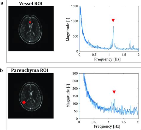 Frequency analysis of a bSSFP. A 50˚flip50˚flip angle indicating a... | Download Scientific Diagram