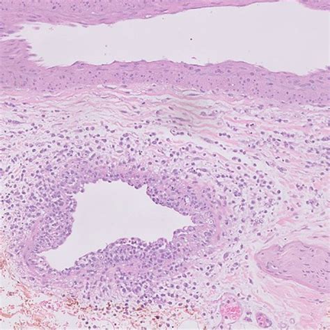 Case 1. Biopsy of lesion showed medium-vessel vasculitis with a ...