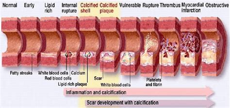 How To Reverse 20 Years Of Arterial Plaque Prevmedhealth