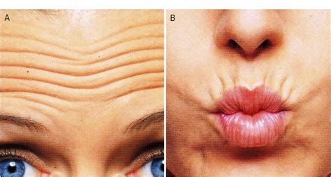 Figure From Prevention Of Hyper And Hypotrophic Scars Through