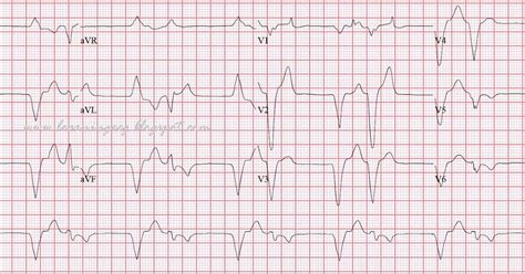 ECG Rhythms: Reciprocal Beating in a Paced Rhythm