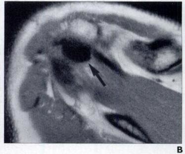 Year Old Man With Recurrent Pain Year After Debridement Of Calcific