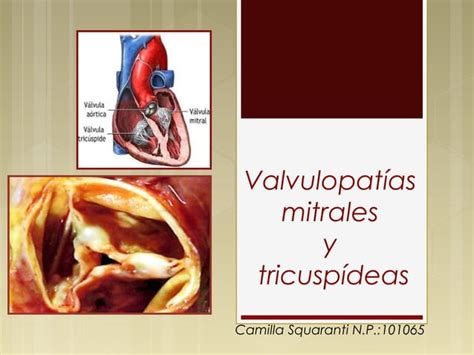 Valvulopat A Mitral Y Tric Spide Ppt