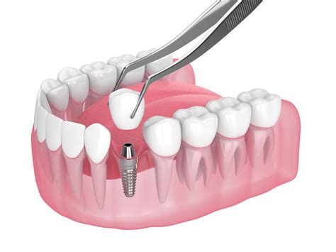 Immediate Loading Implantology Turismo Dentale