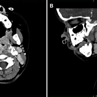 A Axial Contrast Enhanced Ct Scan Of A Year Old Patient Showing A