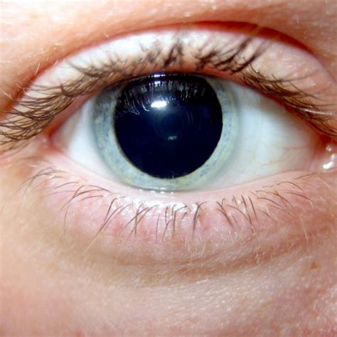 Dilated Pupils Causes Risks And Treatments