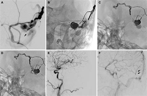 Figure From Transarterial Onyx Embolization With Targeted Balloon