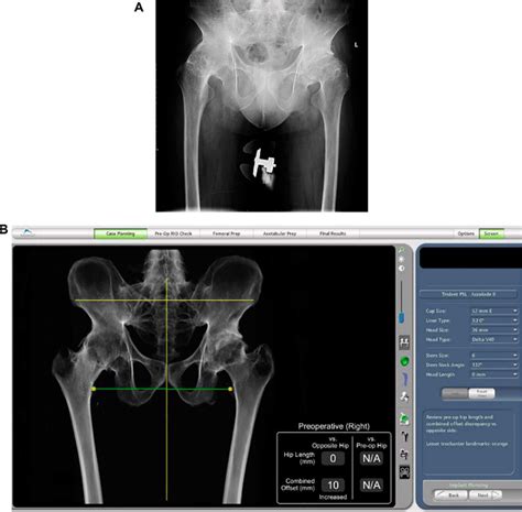 Preoperative X Rays And Three Dimensional Model Construction Of The Download Scientific Diagram