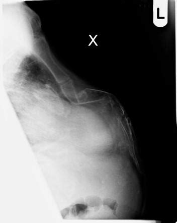 Sternal Fracture Radiology Case Radiopaedia Org