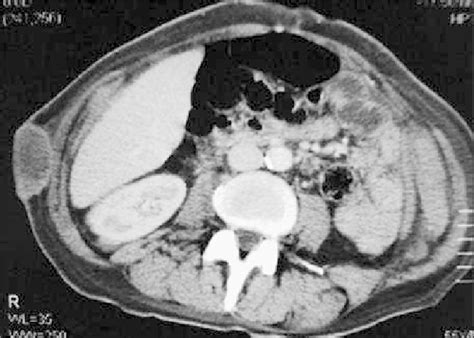 Abdominal Ct Scan Showing Representative Cutaneous Metas Tase