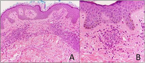 Cutaneous Leukocytoclastic Vasculitis As The Presenting Sign Of