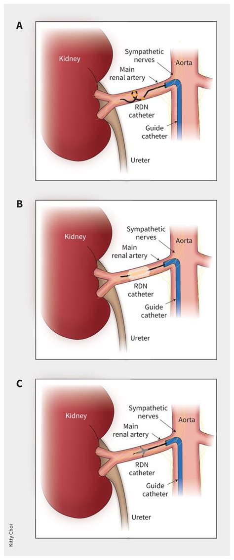 Renal Denervation For Uncontrolled Hypertension Cmaj