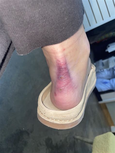 Chronic pain to knee and ankle : r/Orthopedics