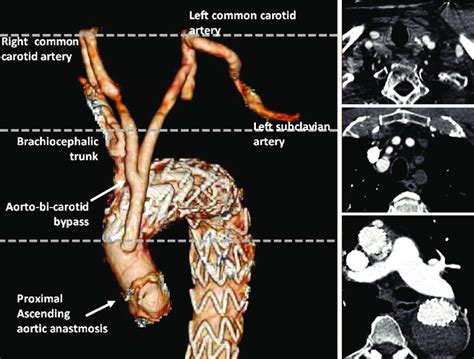 Three-dimensional reconstruction from CT scan images of the ascending ...