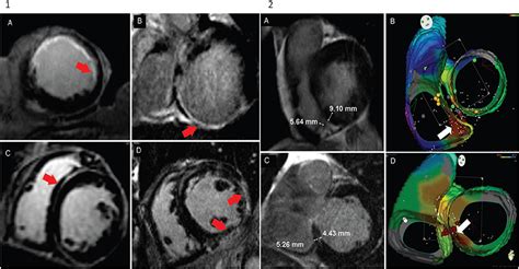 Frontiers Cardiac Magnetic Resonance For Ventricular Tachycardia