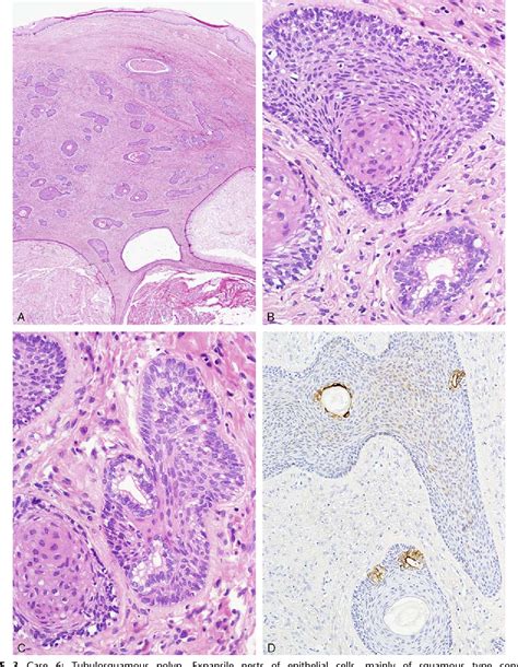 Prostatic Type Tissue In The Lower Female Genital Tract A Morphologic