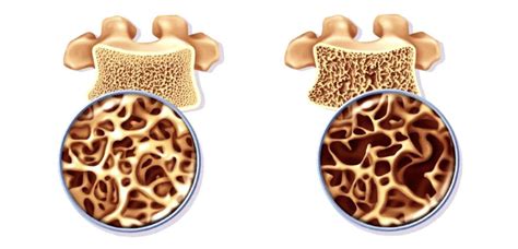 Osteopenia: Symptoms of Osteopenia