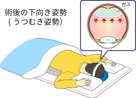 黄斑下出血の原因と手術治療｜茨城県水戸市の小沢眼科内科病院