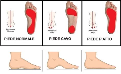 Il Piede Cavo Cause Sintomi Diagnosi Podartis