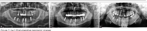 Pdf The Vertical Soft Tissue Thickness And Subcrestal Implant