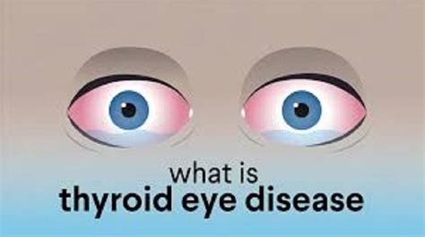 Thyroid Eye Disease Market Share Epidemiology Analysis