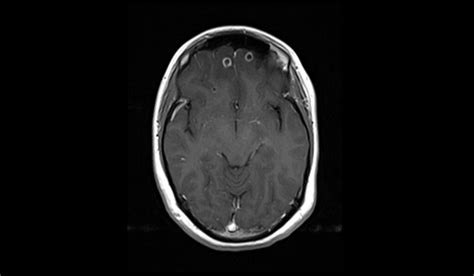 Neurocysticercosis Mri Radiology Article On Neurocysticercosis