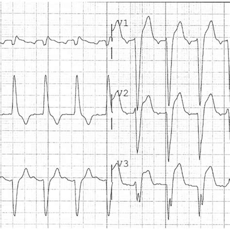 ECG of a patient with AV sequential pacing fulfilling the Barcelona ...