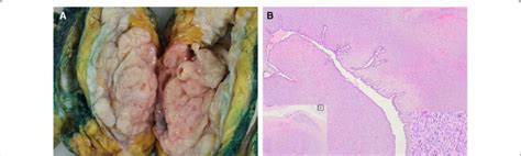 A Macroscopic Appearance Of Cut Surface Of The Tumor Composing Of