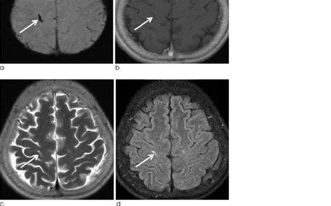 A 61-years-old female patient with parenchymal hemorrhage. SWI (a)... | Download Scientific Diagram