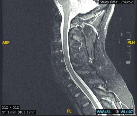 Mri Cervical T Weighted Sagittal Section Showing No Hemorrhage Edema