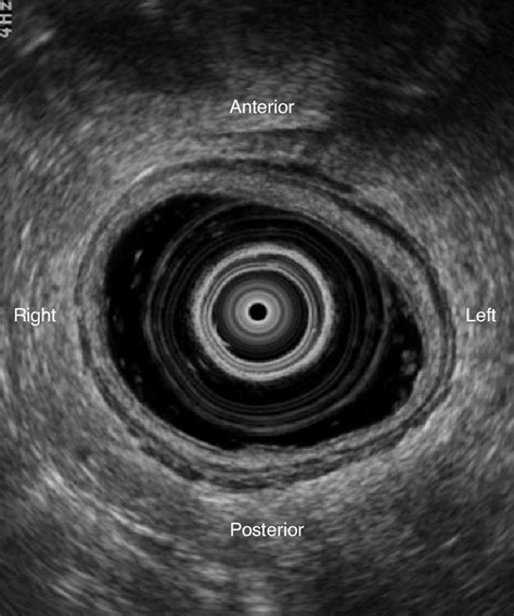 Optimal Transrectal Ultrasonography Scan The Axial View Clearly Shows Download Scientific