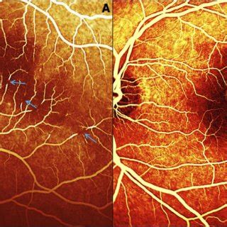 A Fundus Fluorescein Angiography Ffa Image Of The Subject S Left