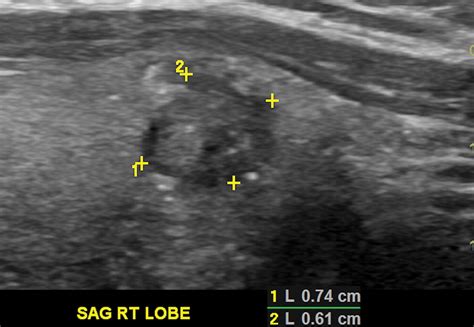 Assessment Of American College Of Radiology Thyroid Imaging Reporting