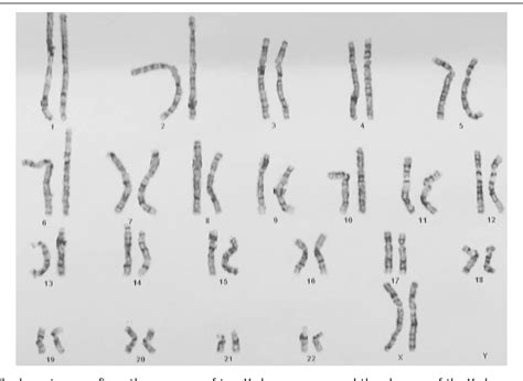 PDF SRY Positive 46 XX Testicular Disorder Of Sex Development As A