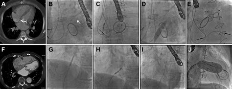 Anatomic Approach To Transseptal Puncture For Structural Heart