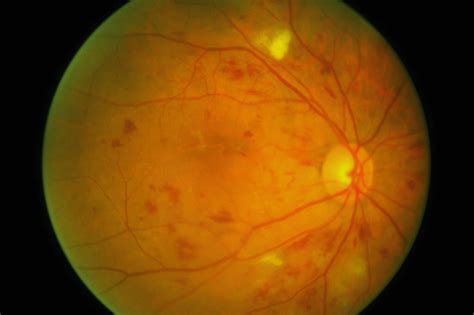 Diabetic Retinopathy Clinical Features Geeky Medics