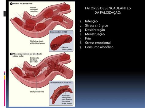 Ppt Caso Cl Nico Anemia Falciforme Powerpoint Presentation Free