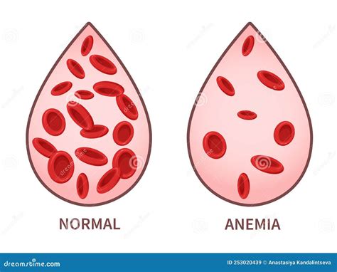 Hemoglobin Anemia Symptoms Blood Disease Health Care Concept Stock