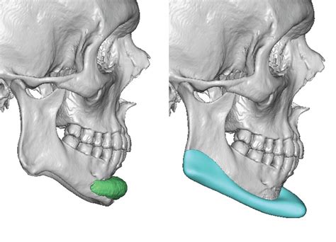 Male Custom Jawline Implant Replacement Design Side View Dr Barry