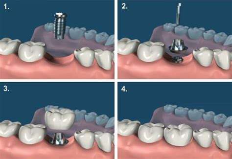 Le Processus D Installation D Implants Dentaires CRFI