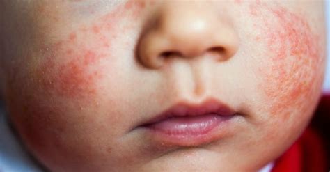 How To Treat Baby Eczema Naturally? - EasyToBeMom