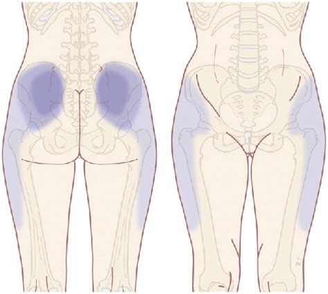 Facet Joint Syndrome | e-algos