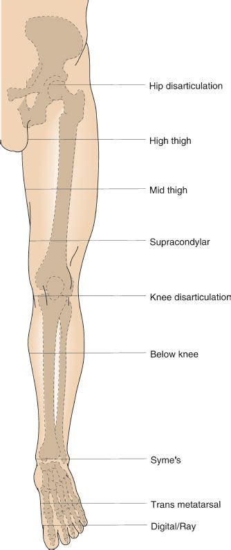 Lower Extremity Amputation Basicmedical Key