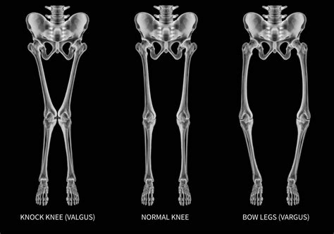 Genu Varum Définition Causes Traitements Des Jambes Arquées