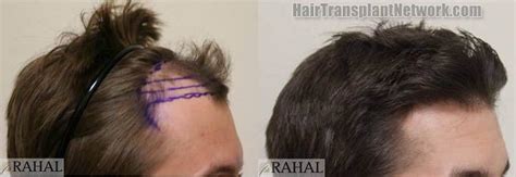 Dr H Rahal Hair Transplantation Procedure Before And After