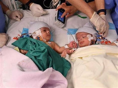 Saudi Yemeni Conjoined Twins Successfully Separated In 8 Hr Surgery