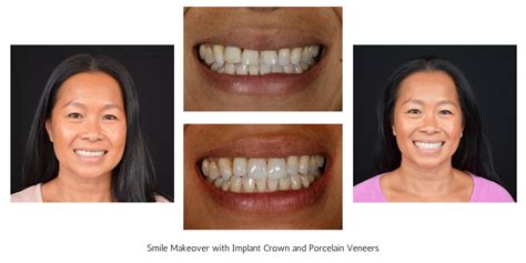 Joyful Smiles Before And After Makeovers Dr Joy Brauer