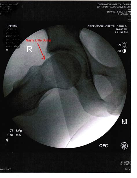 The Chronology of My Femoroacetabular Impingement (FAI) and Surgery ...